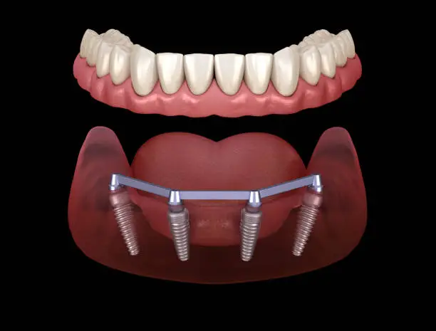 Journey to an Excellent Bite: Dental Implants and Long-Term Comfort